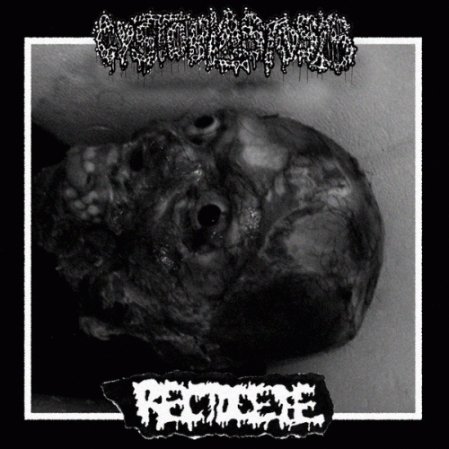 Cystoblastosis : Cystoblastosis - Rectocele